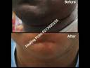 Hyper Pigmentation Case